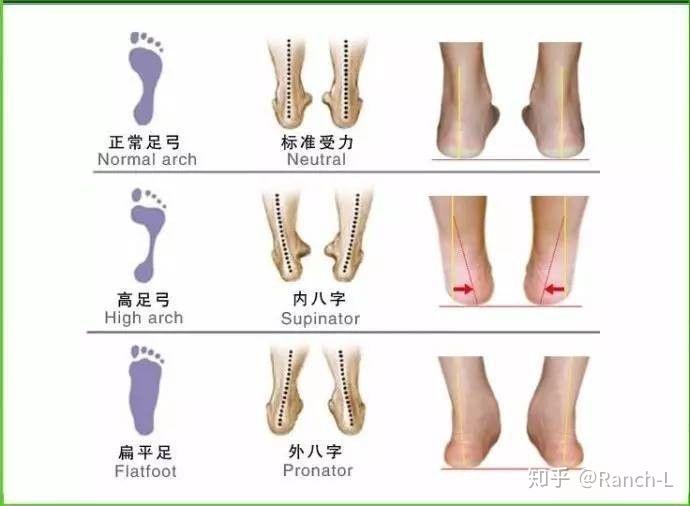 一,足弓如何测量,判断
