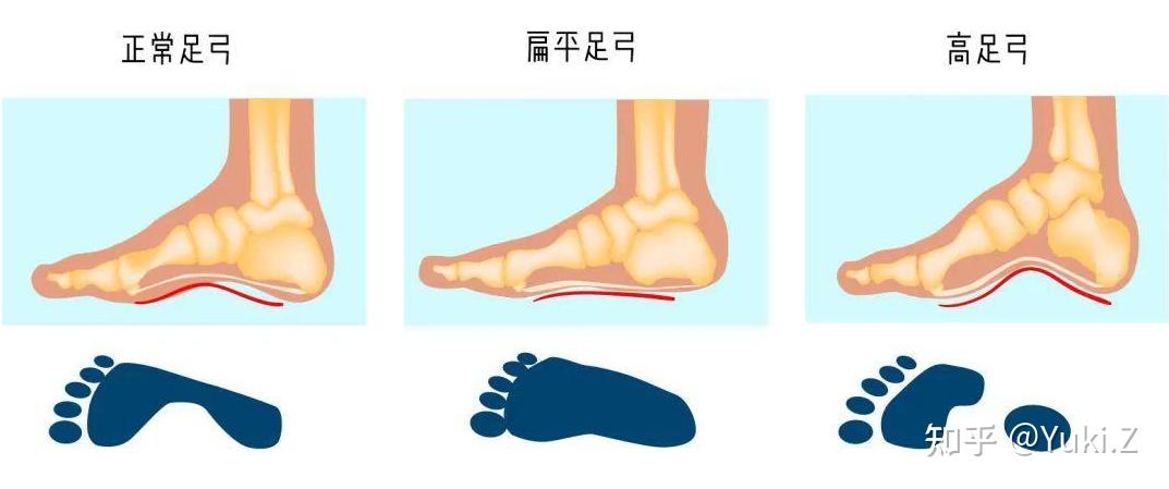 二,判断自己跑步落地姿势:外翻,内翻